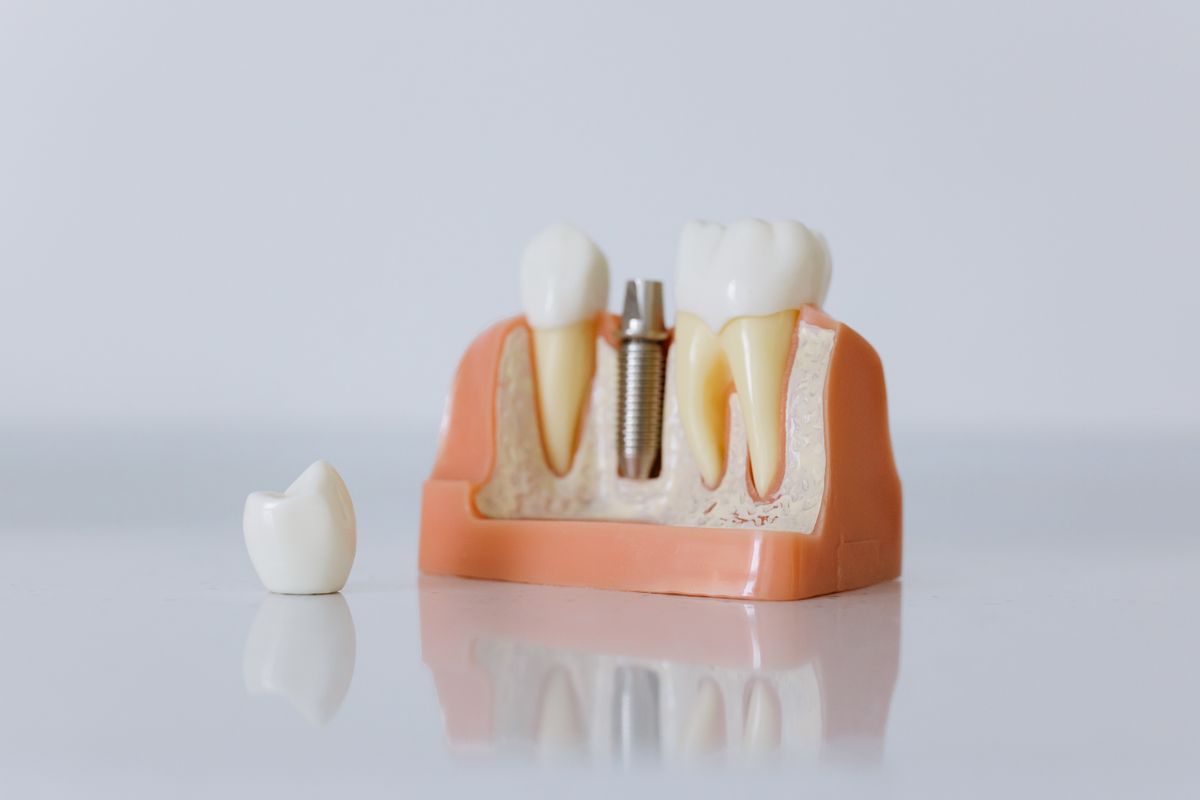 Mô hình cấy ghép Implant