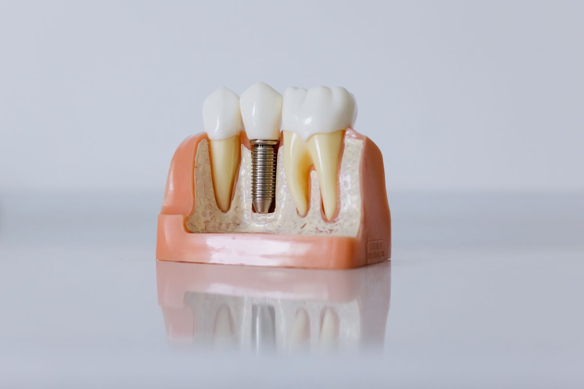 Cấy ghép Implant