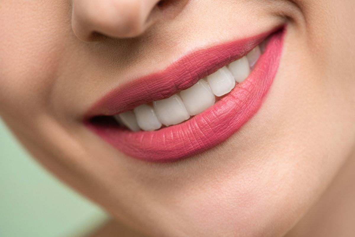 Veneer thẩm mỹ